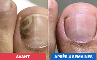 Antes e depois — Antônio